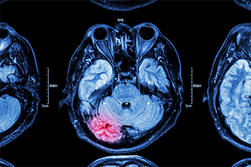 Brain and Spinal Cord Injuries